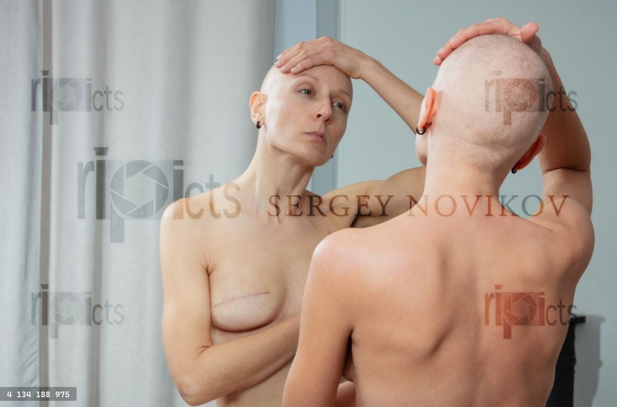 Hairless topless woman studies mastectomy scars in reflection