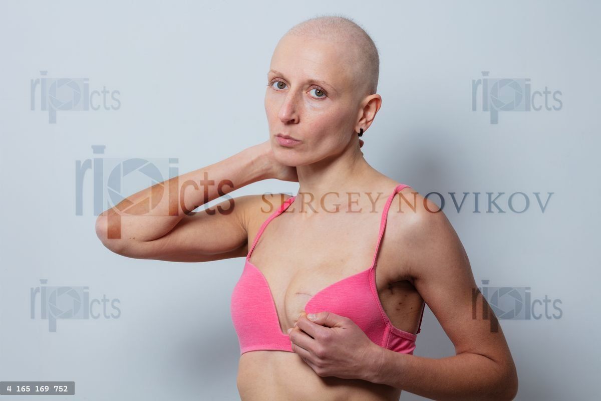 Woman's post-mastectomy close-up, surgical scars seen under