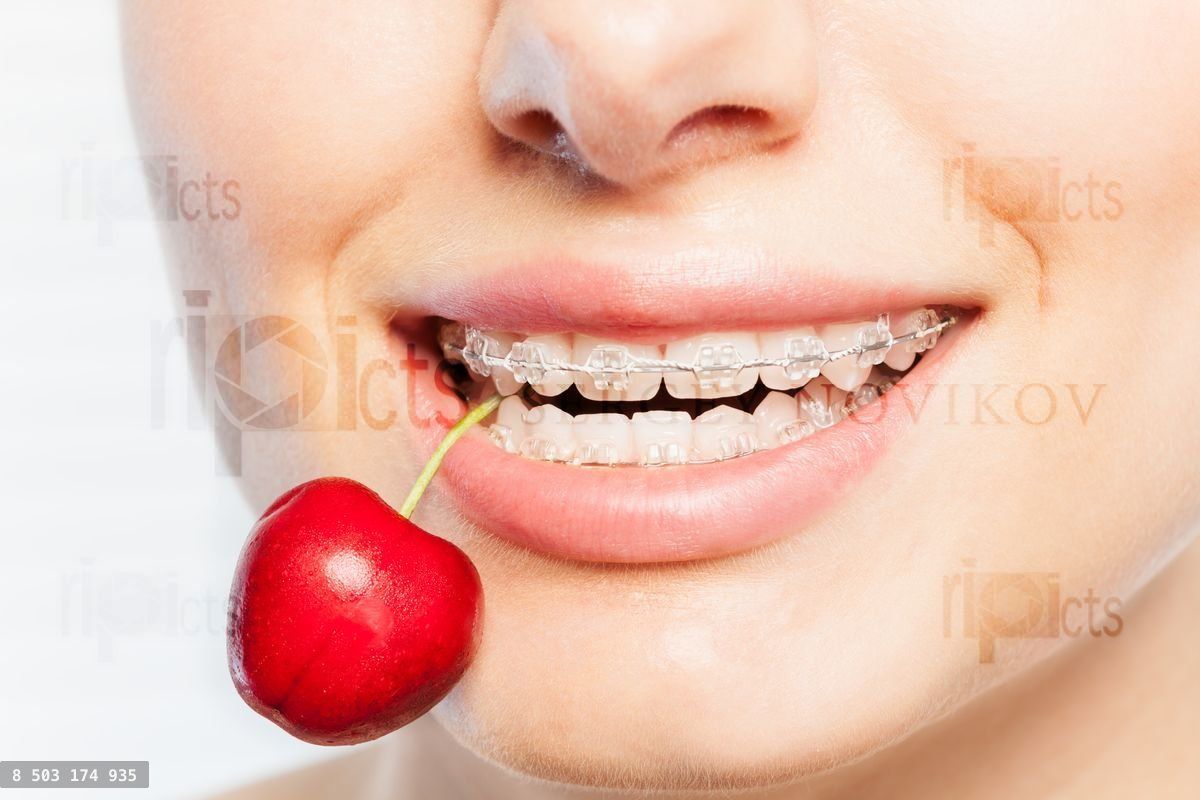 Woman's teeth with braces biting off ripe cherry