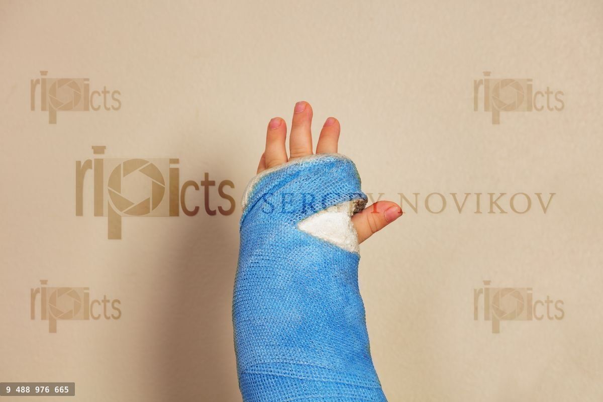 Broken hand blue plaster cast after accident focus on the palm