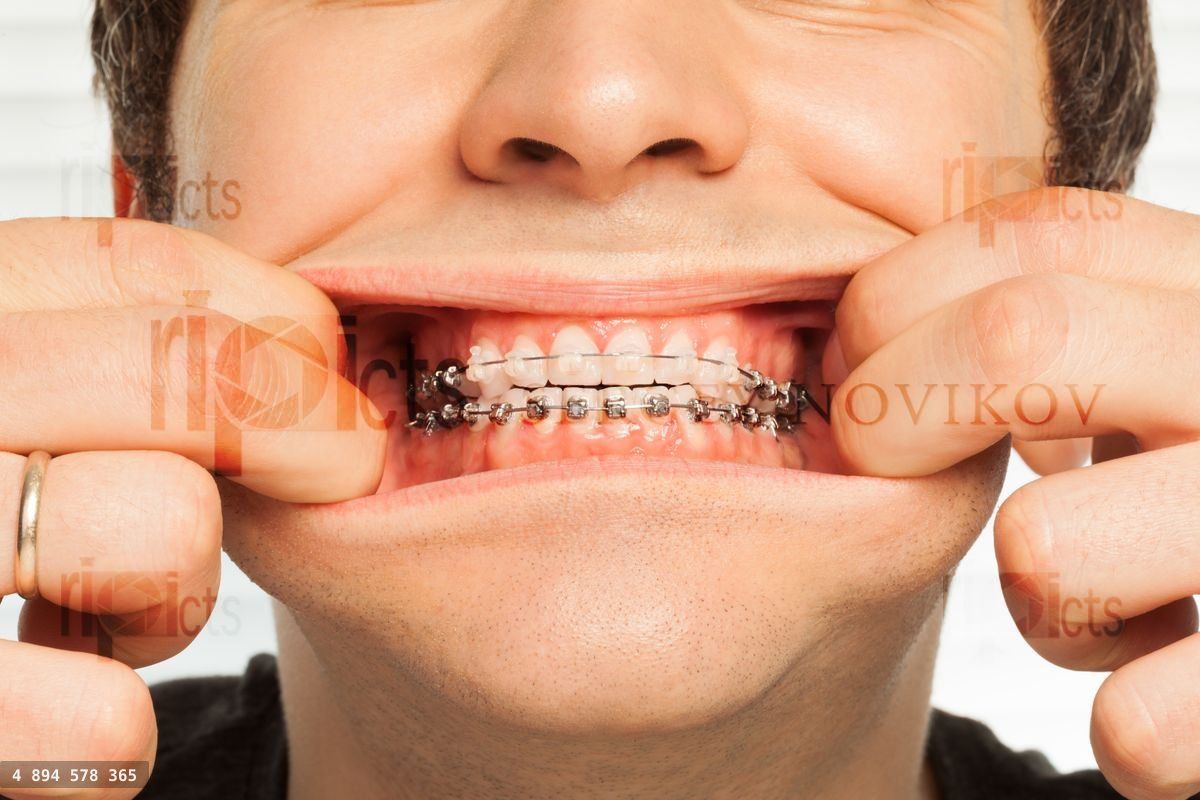 Close up picture of man showing dental braces