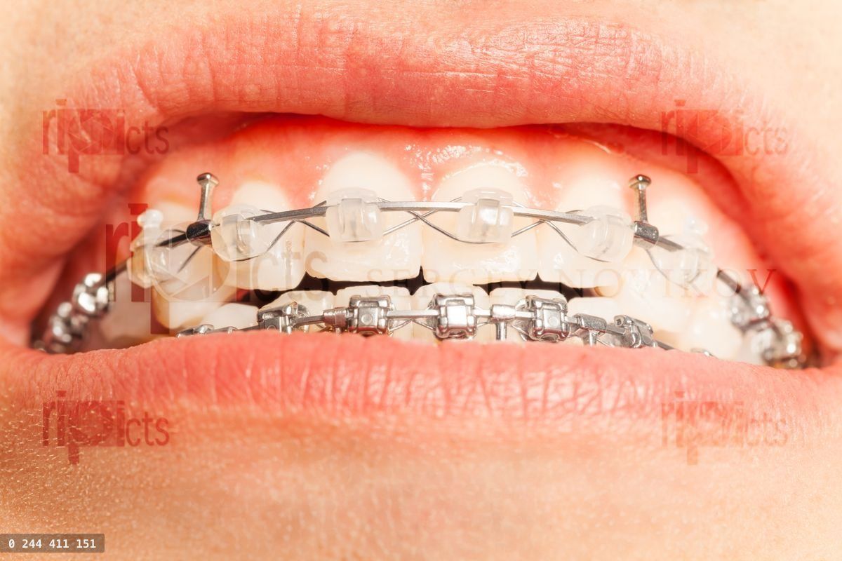 Close up of man mouth with tooth correction braces