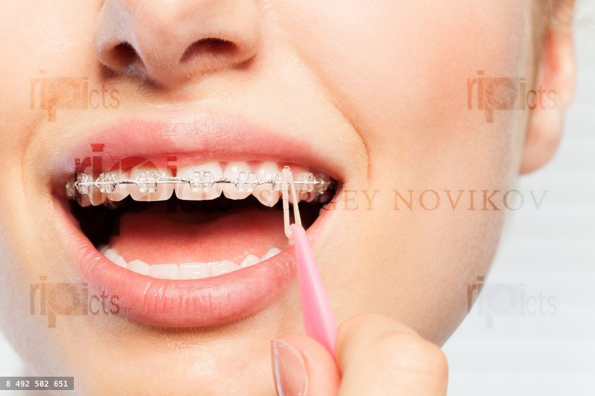 Woman wearing the elastics over hook of bracket