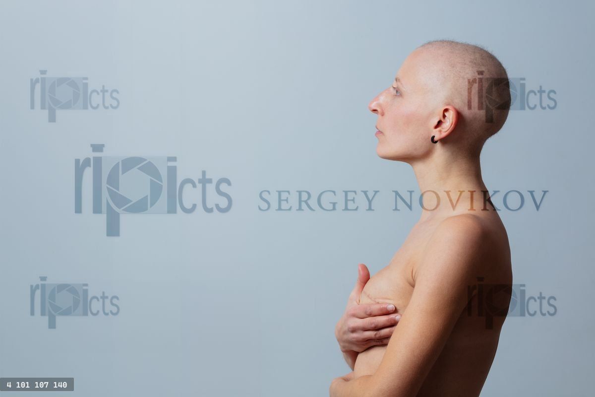 Woman with shaved head hold breast after mastectomy operation
