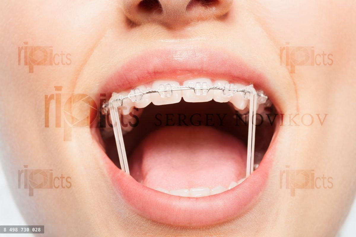 Woman mouth with orthodontic elastics on braces