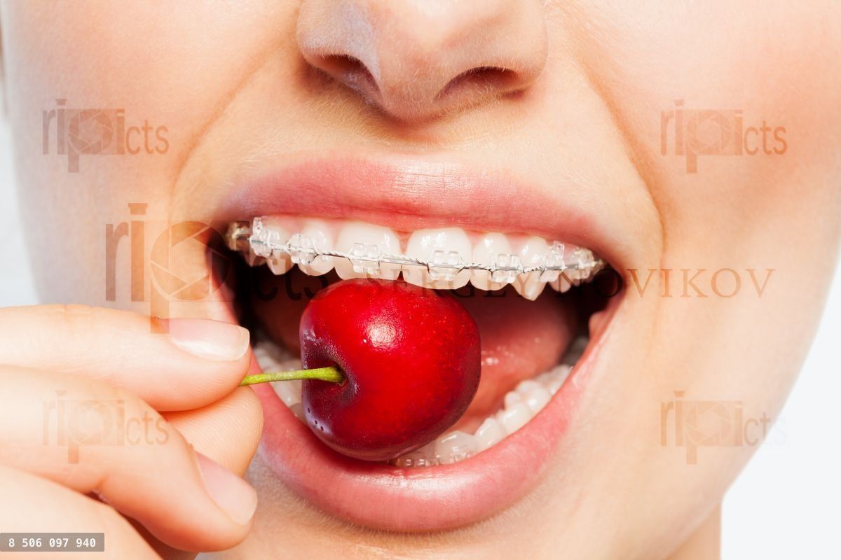 Woman with dental braces biting off ripe cherry