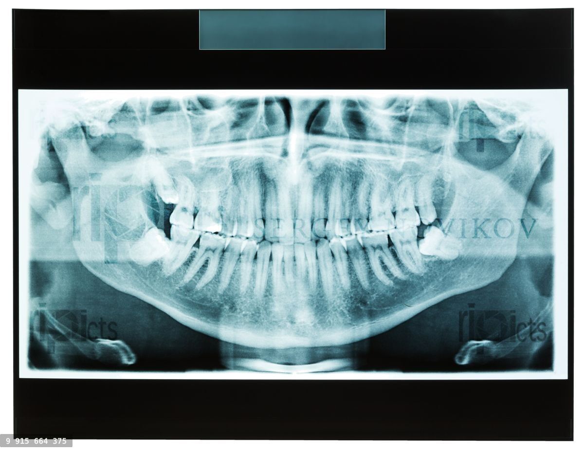 Closeup of man xray jaw for dental teeth doctor