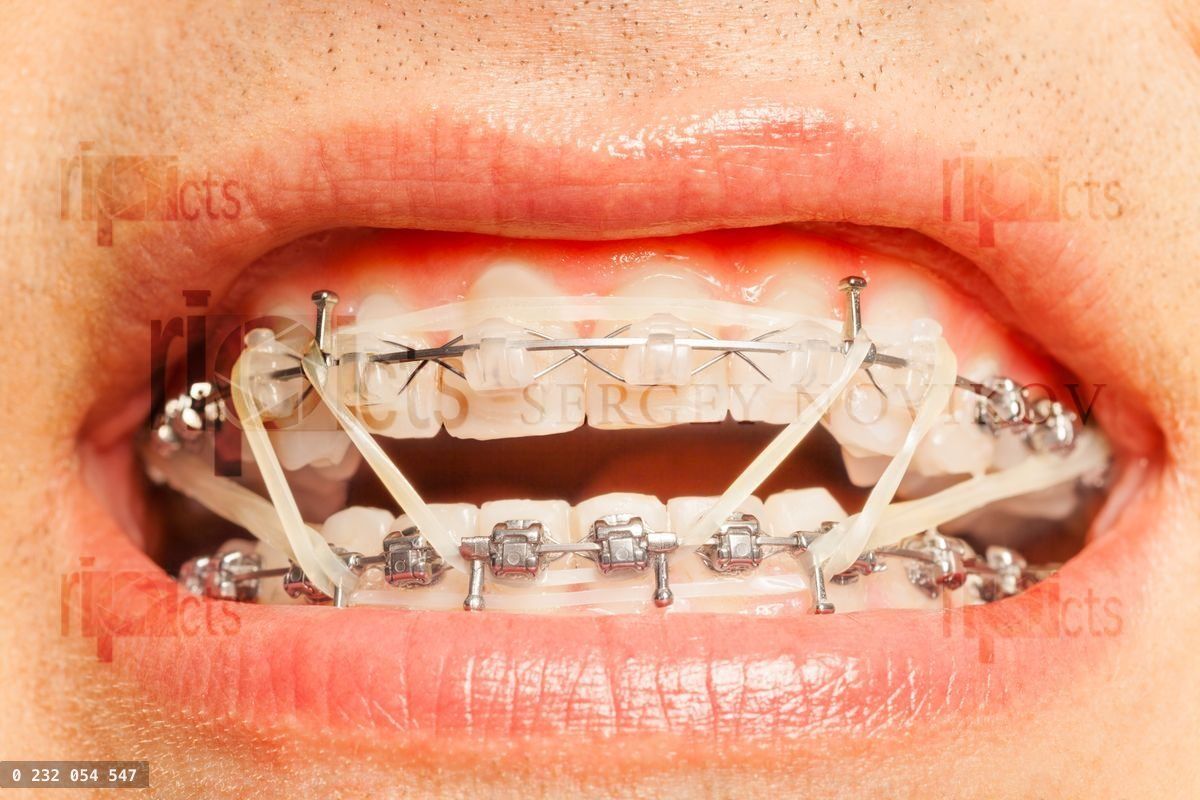 Brackets dentales con anillos de corrección ortodôntica