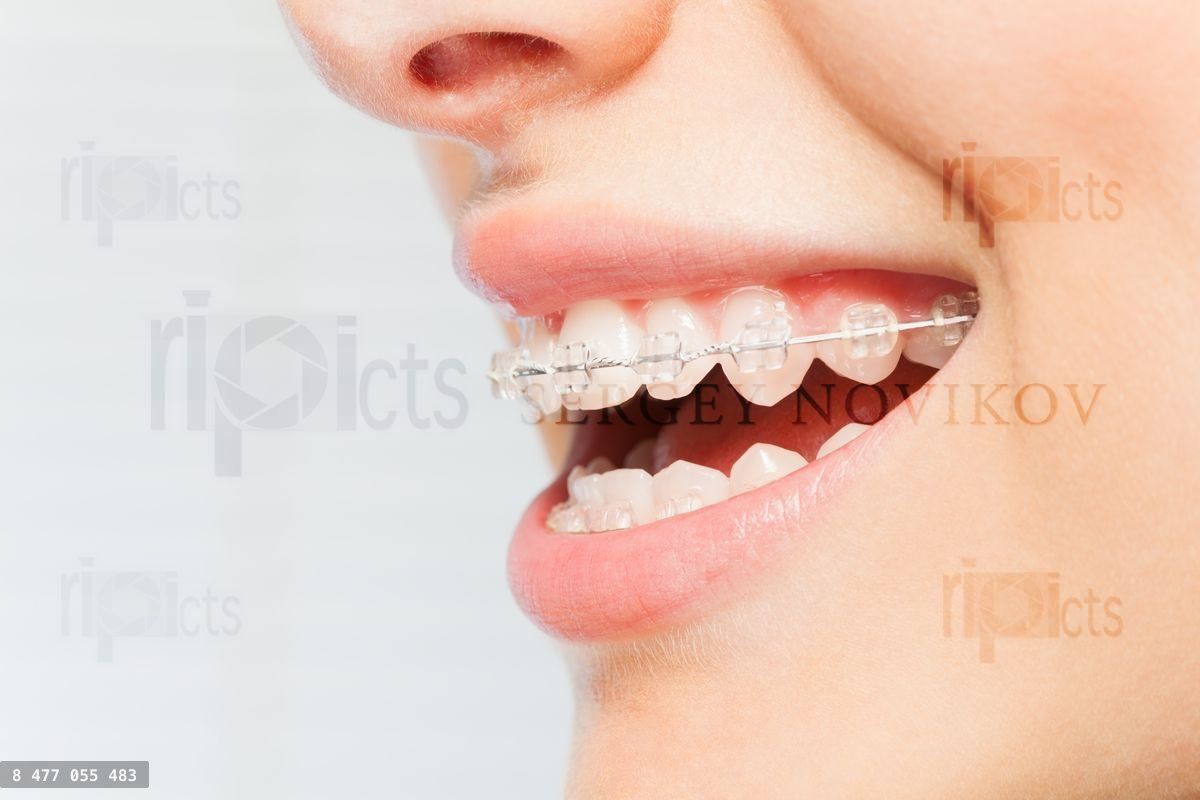 Woman's smile with clear dental braces on teeth