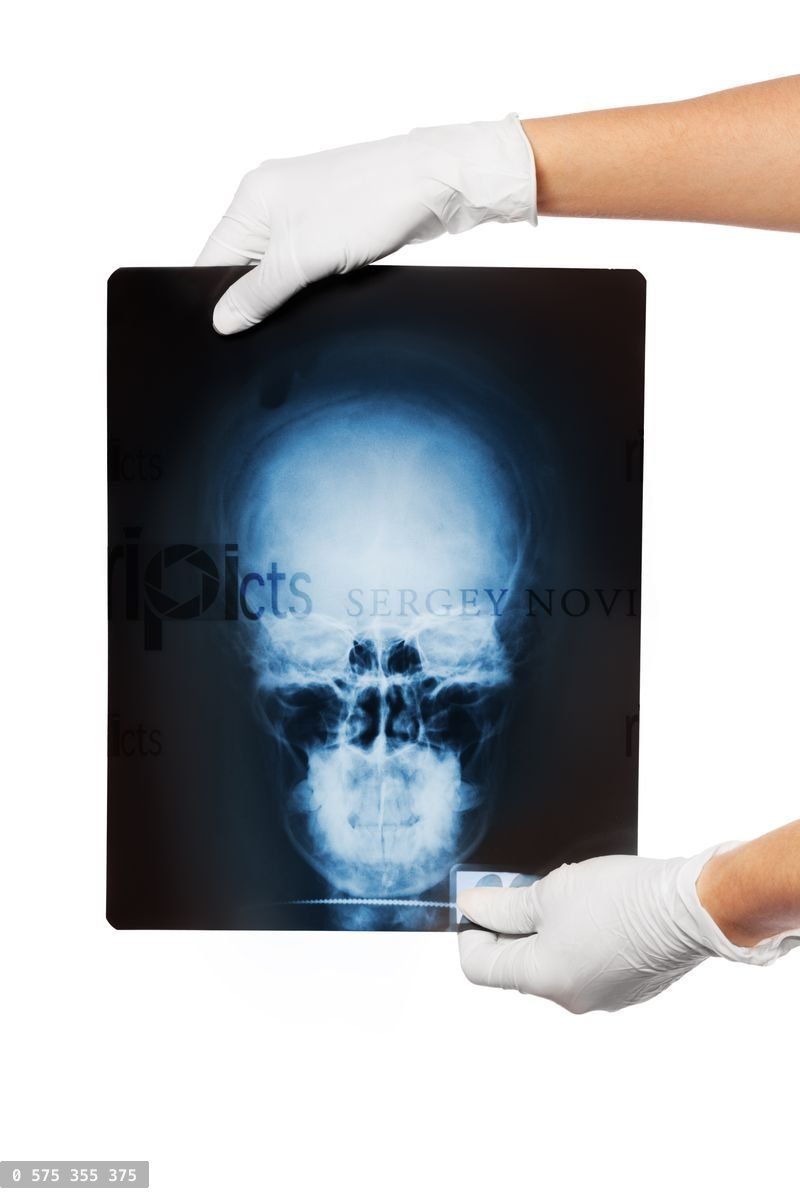 X ray of patient scull in doctor hands