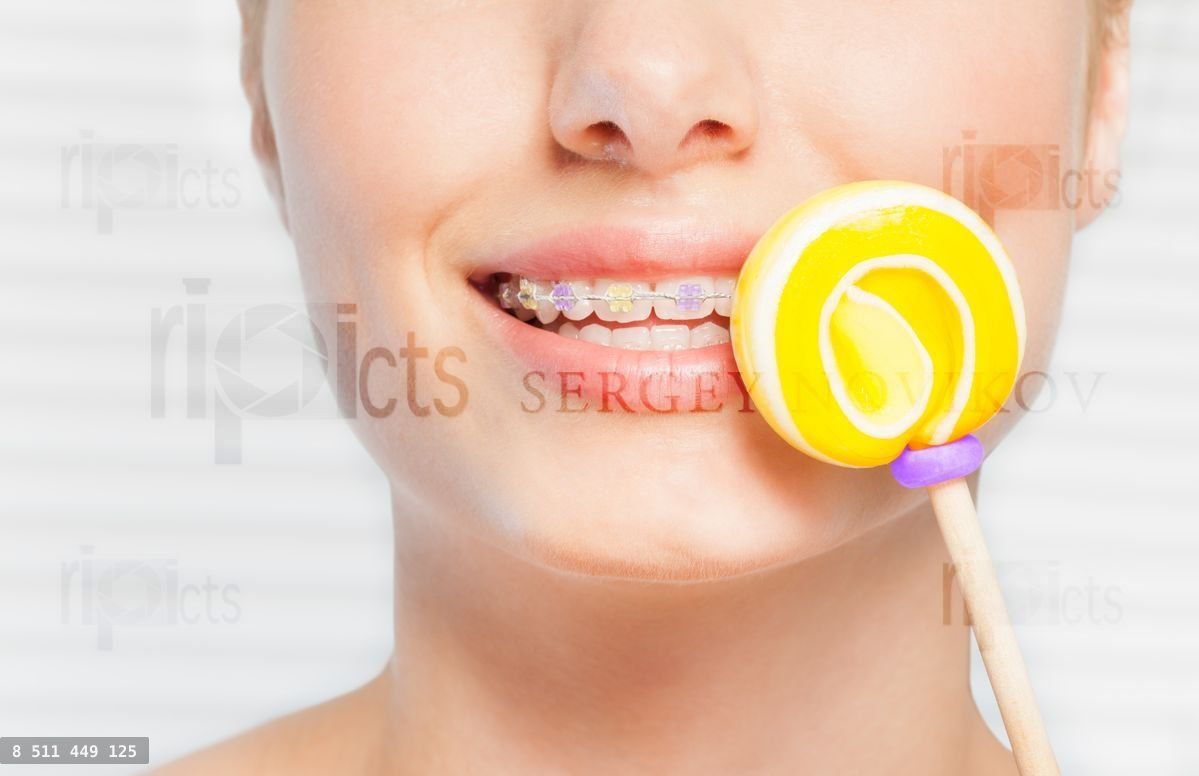 Woman with dental braces holding yellow lollipop